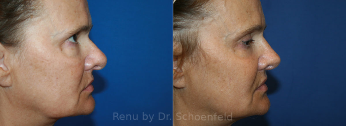 Rhinoplasty Before and After Photos in DC, Patient 13627