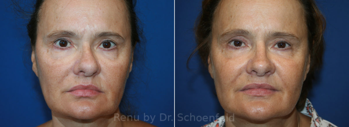 Rhinoplasty Before and After Photos in DC, Patient 13627