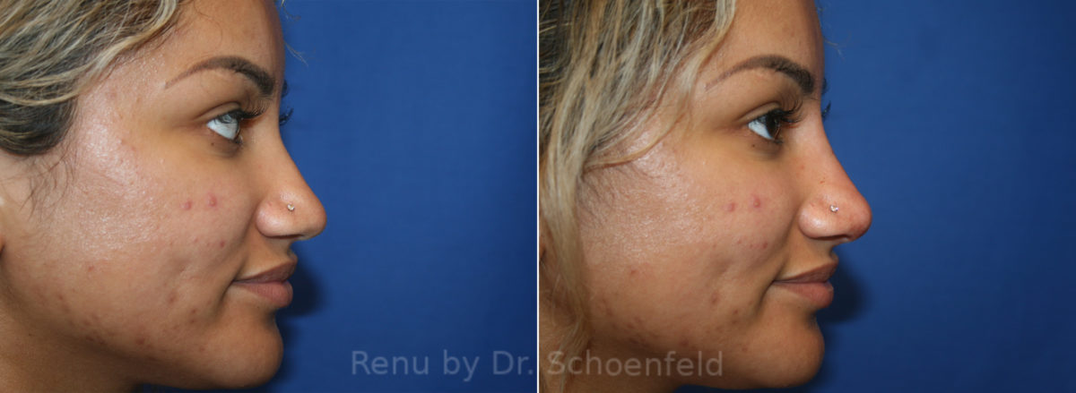 Non-Surgical Rhinoplasty Before and After Photos in DC, Patient 13656