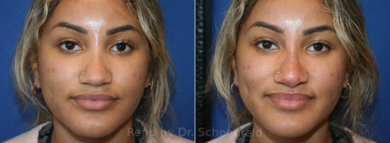 Non-Surgical Rhinoplasty Before and After Photos in DC, Patient 13656
