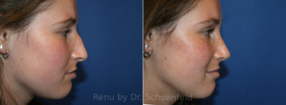 Rhinoplasty Before and After Photos in DC, Patient 13668