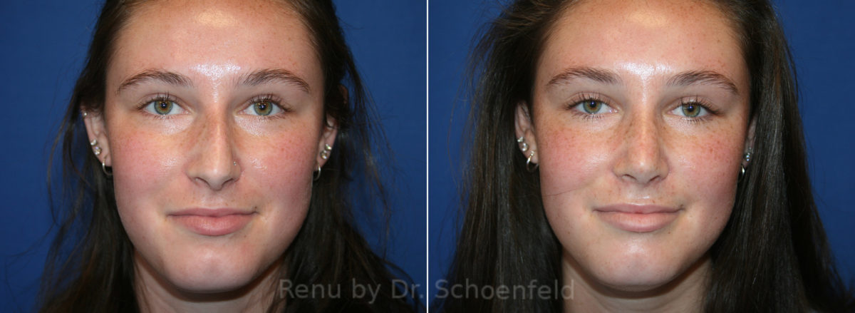Rhinoplasty Before and After Photos in DC, Patient 13668