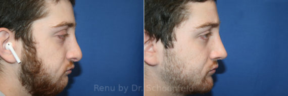 Chin Implant Before and After Photos in DC, Patient 13693