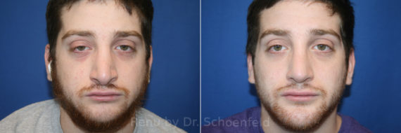 Chin Implant Before and After Photos in DC, Patient 13693