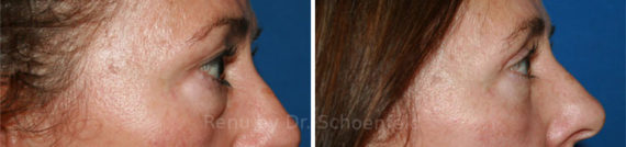 Blepharoplasty Before and After Photos in DC, Patient 7265