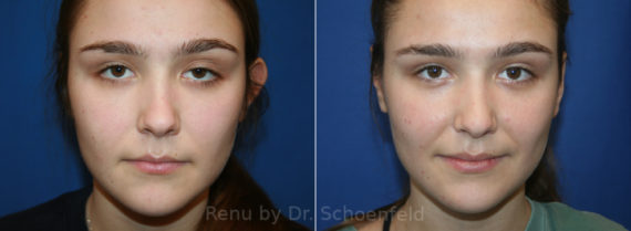 Otoplasty Before and After Photos in DC, Patient 13700