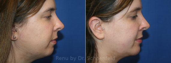 Chin Implant Before and After Photos in DC, Patient 13701