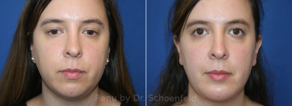 Chin Implant Before and After Photos in DC, Patient 13701