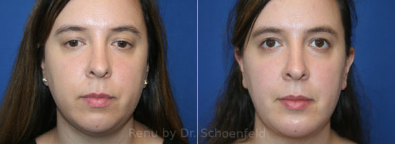 Chin Implant Before and After Photos in DC, Patient 13701