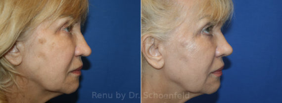 Rhinoplasty Before and After Photos in DC, Patient 13702