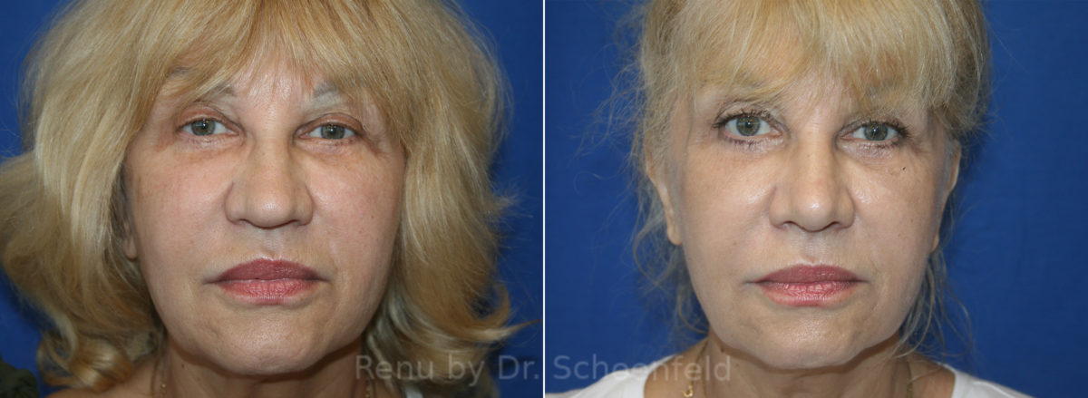 Rhinoplasty Before and After Photos in DC, Patient 13702