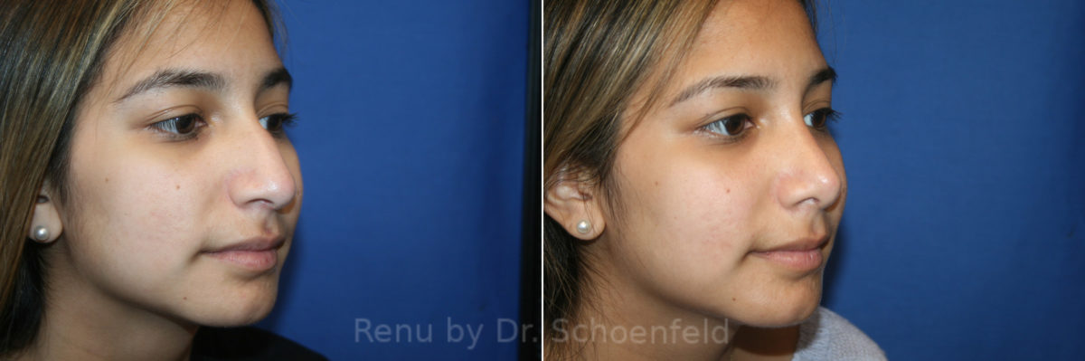 Rhinoplasty Before and After Photos in DC, Patient 13721