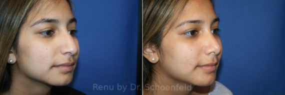 Rhinoplasty Before and After Photos in DC, Patient 13721