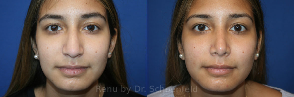 Rhinoplasty Before and After Photos in DC, Patient 13721