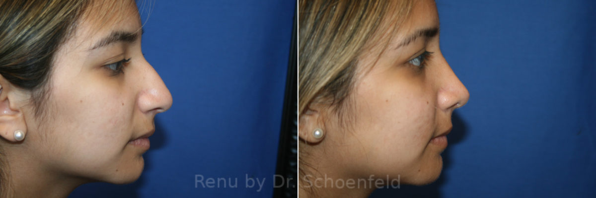 Rhinoplasty Before and After Photos in DC, Patient 13721