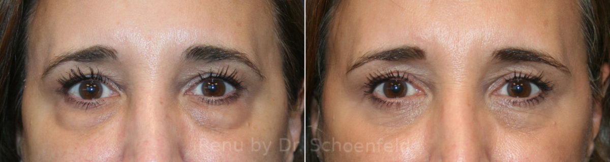 Blepharoplasty Before and After Photos in DC, Patient 13759