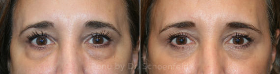 Blepharoplasty Before and After Photos in DC, Patient 13759