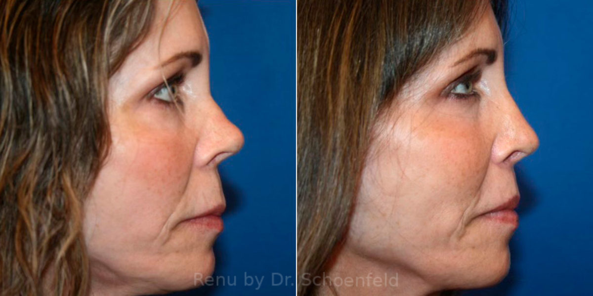 Revision Rhinoplasty Before and After Photos in DC, Patient 13790