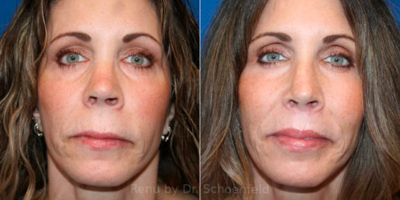 Revision Rhinoplasty Before and After Photos in DC, Patient 13790
