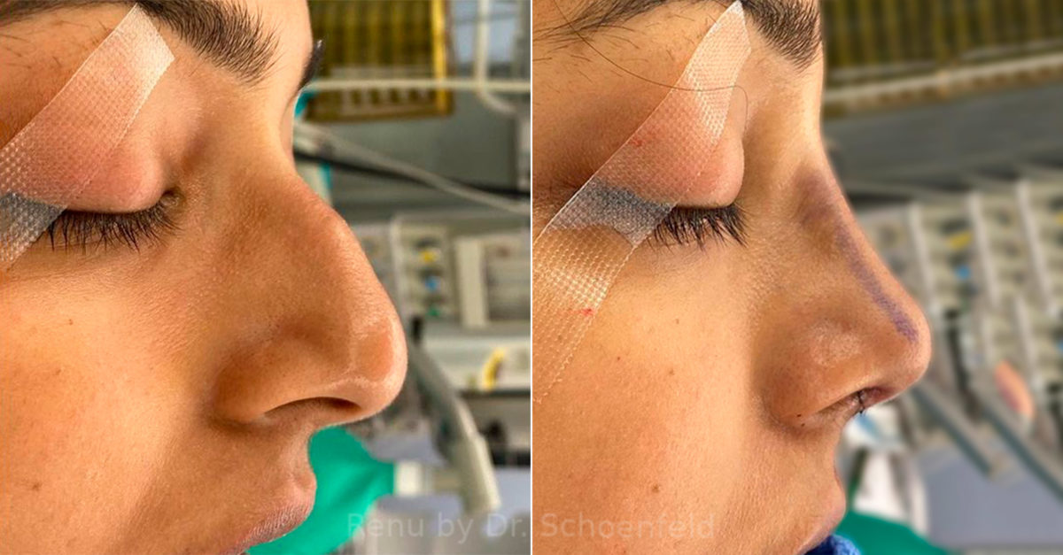 Rhinoplasty Before and After Photos in DC, Patient 13797