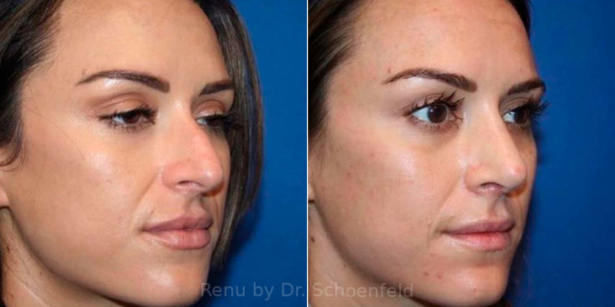 Rhinoplasty Before and After Photos in DC, Patient 13818