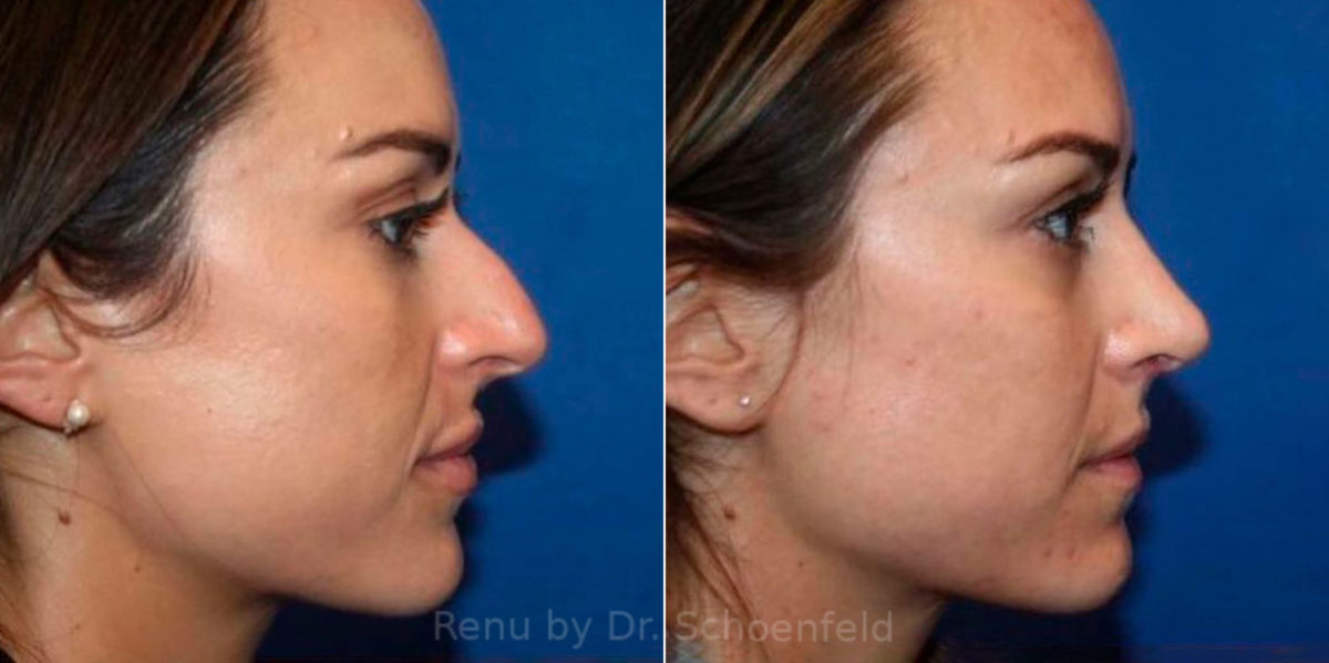 Rhinoplasty Before and After Photos in DC, Patient 13818