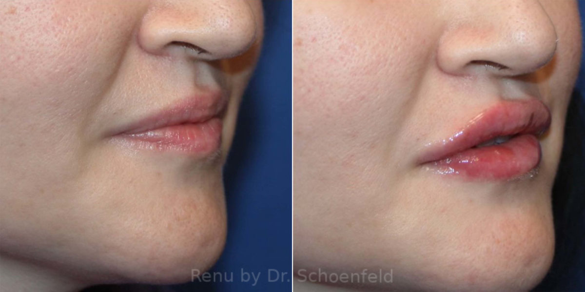 Dermal Filler Before and After Photos in DC, Patient 13825