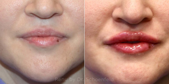 Dermal Filler Before and After Photos in DC, Patient 13825