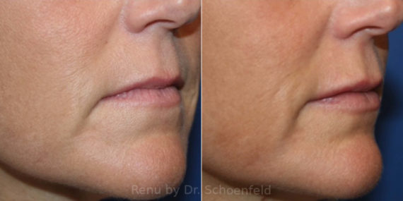 Dermal Filler Before and After Photos in DC, Patient 13827