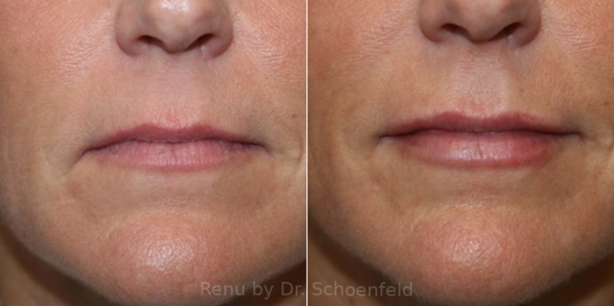 Dermal Filler Before and After Photos in DC, Patient 13827