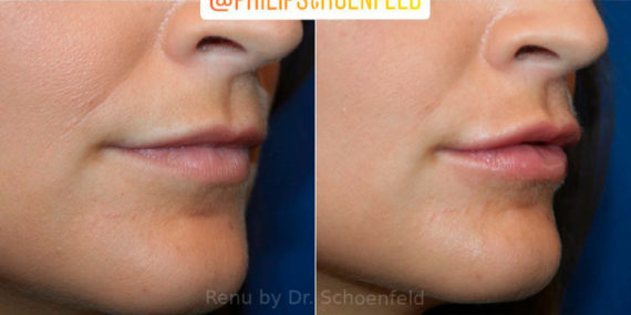 Dermal Filler Before and After Photos in DC, Patient 13840