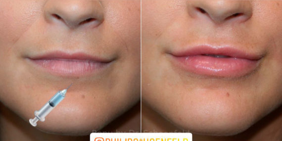 Dermal Filler Before and After Photos in DC, Patient 13840