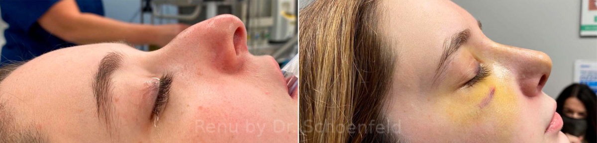 Rhinoplasty Before and After Photos in DC, Patient 13847