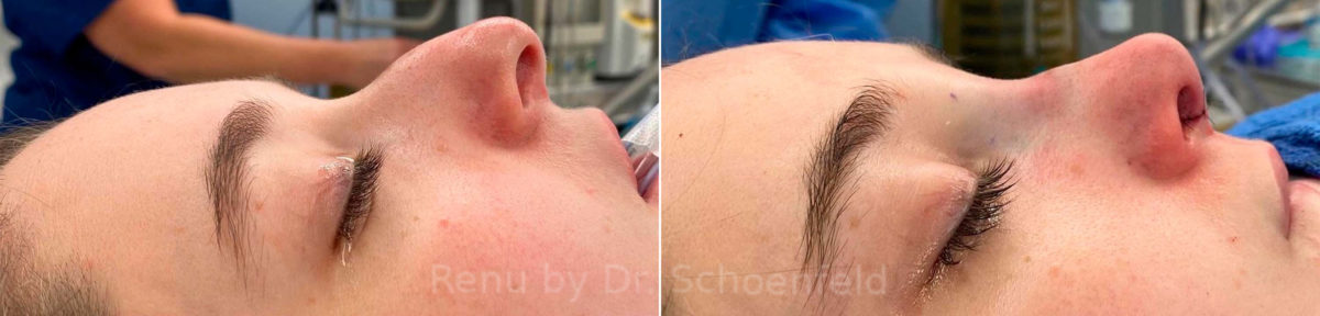 Rhinoplasty Before and After Photos in DC, Patient 13847