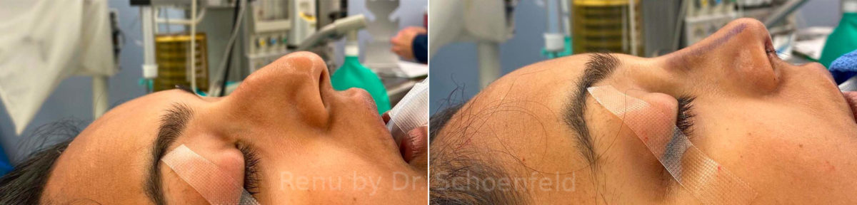 Rhinoplasty Before and After Photos in DC, Patient 13848