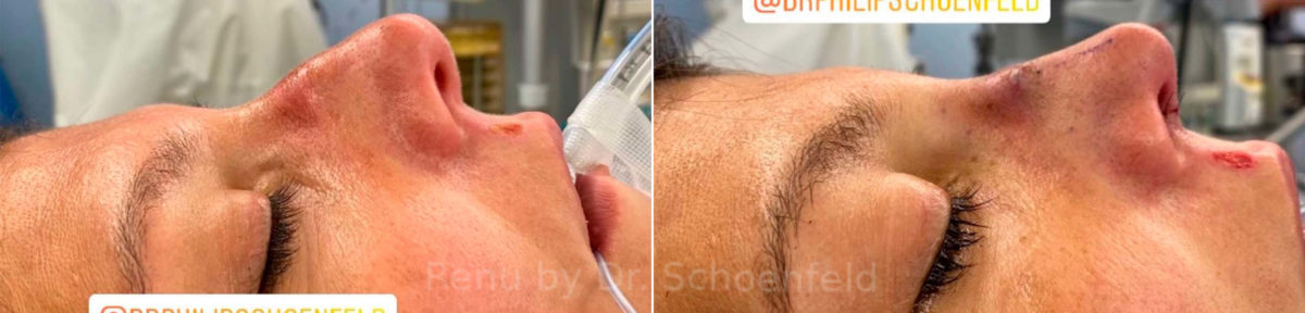 Rhinoplasty Before and After Photos in DC, Patient 13849