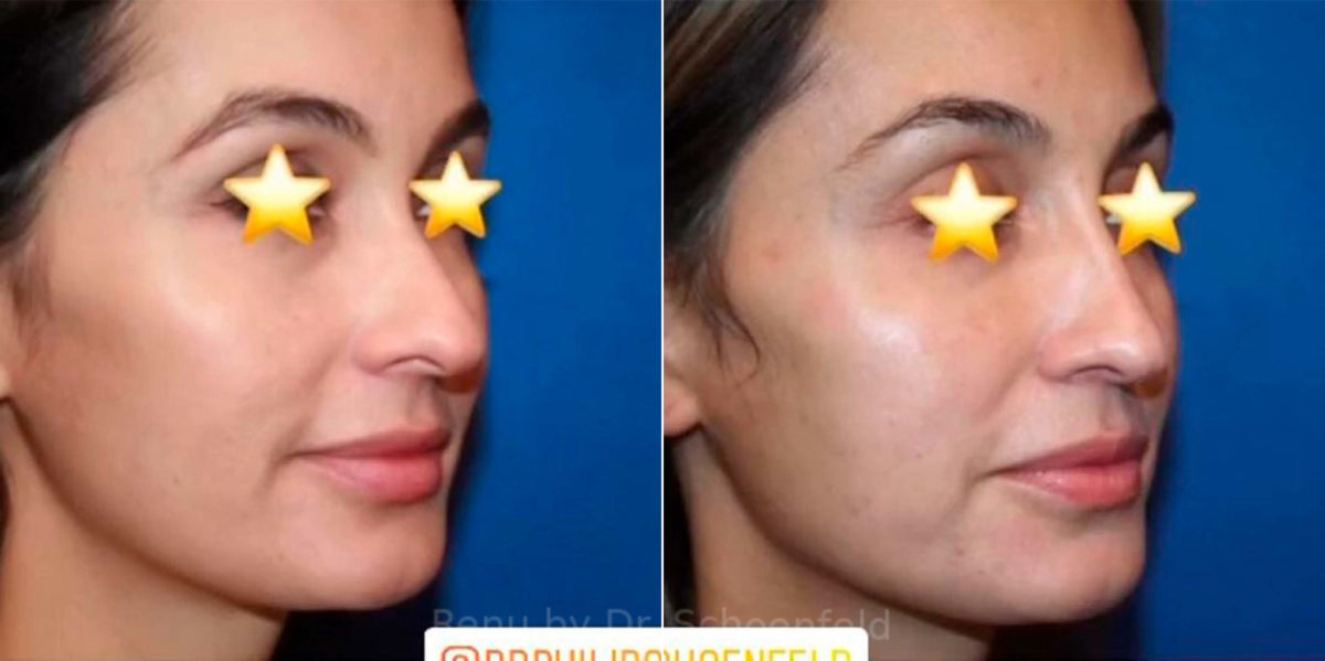 Rhinoplasty Before and After Photos in DC, Patient 13852