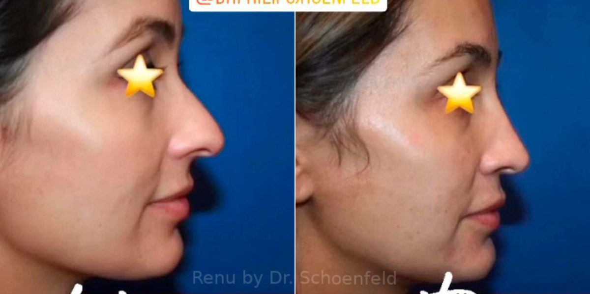 Rhinoplasty Before and After Photos in DC, Patient 13852