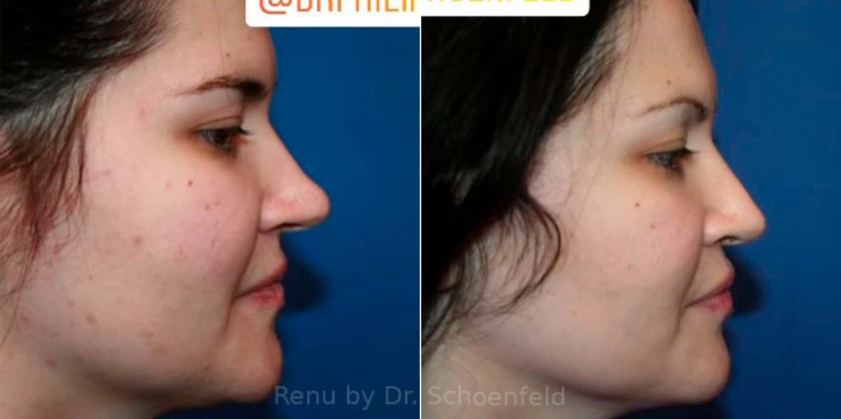 Rhinoplasty Before and After Photos in DC, Patient 13853