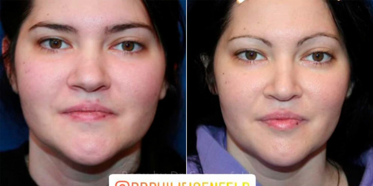 Rhinoplasty Before and After Photos in DC, Patient 13853