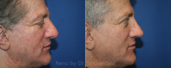 Rhinoplasty Before and After Photos in DC, Patient 13884