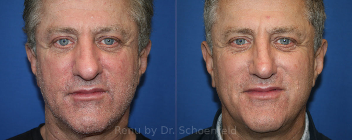 Rhinoplasty Before and After Photos in DC, Patient 13884