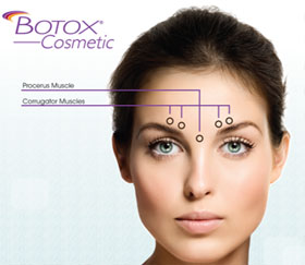 Botox Maryland