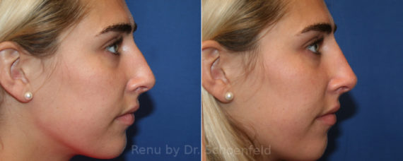 Non-Surgical Rhinoplasty Before and After Photos in DC, Patient 13946