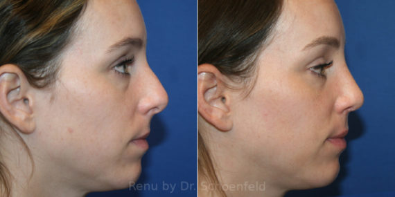 Rhinoplasty Before and After Photos in DC, Patient 13953