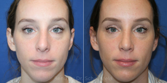 Rhinoplasty Before and After Photos in DC, Patient 13953