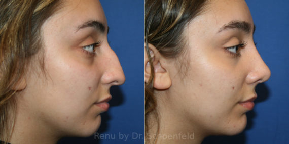 Rhinoplasty Before and After Photos in DC, Patient 13954