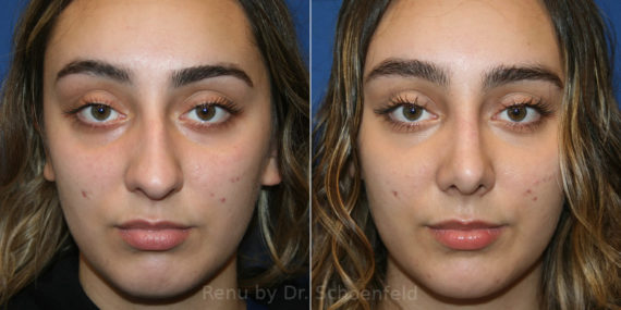 Rhinoplasty Before and After Photos in DC, Patient 13954