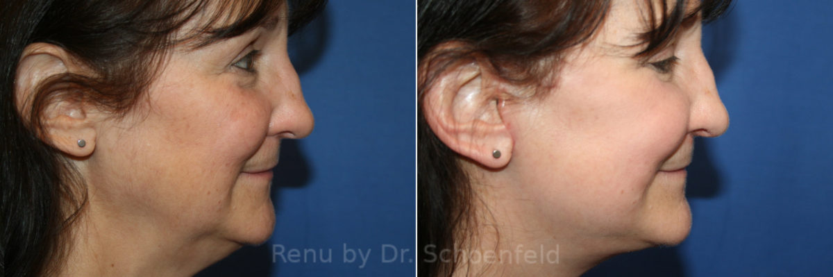 Facelift Before and After Photos in DC, Patient 13982