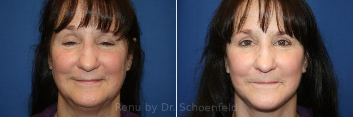 Facelift Before and After Photos in DC, Patient 13982